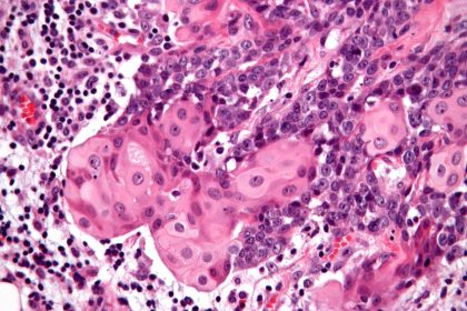 Καρκινωμα NUT: Η σπάνια μορφή καρκίνου που «λύγισε» τον Αλέξανδρο Νικολαΐδη