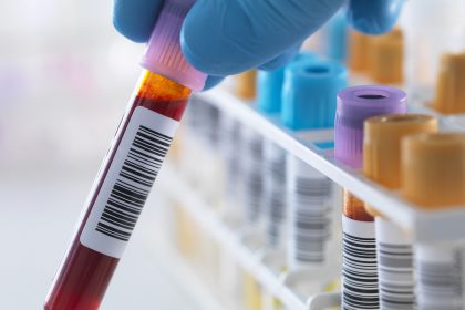«Εξυπνο» τεστ αίματος ανιχνεύει τον καρκίνο του ήπατος