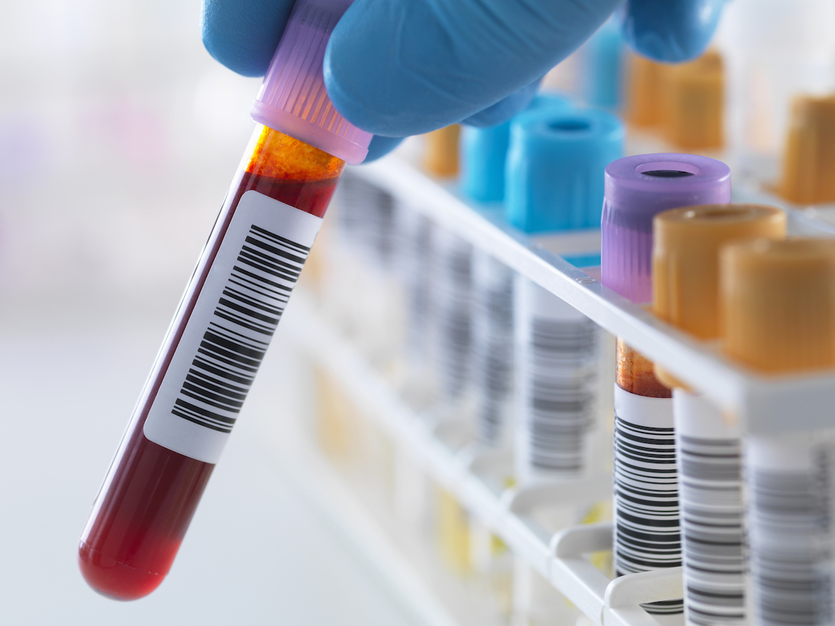 «Εξυπνο» τεστ αίματος ανιχνεύει τον καρκίνο του ήπατος