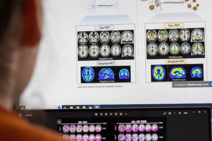 Επιστήμονες ανακάλυψαν πώς πεθαίνουν τα εγκεφαλικά κύτταρα στη νόσο Αλτσχάιμερ