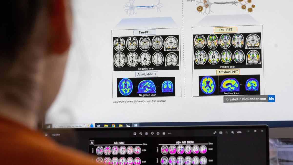 Επιστήμονες ανακάλυψαν πώς πεθαίνουν τα εγκεφαλικά κύτταρα στη νόσο Αλτσχάιμερ
